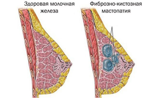 женские болезни