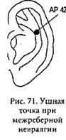Точки рис. Точечный массаж при межреберной невралгии точки. Точечный массаж при межреберной невралгии. Точечный массаж межреберная невралгия. Точки массажа при межреберной невралгии.