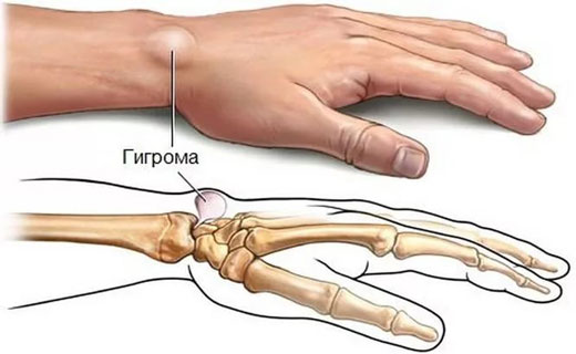 шишка на запястье