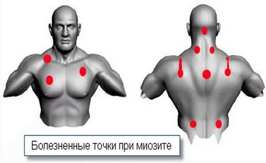 воспаление мышц