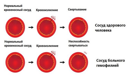 Порфириновая гемофилия обливион как вылечить