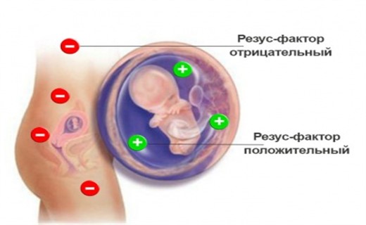 Гбн у новорожденных картинки