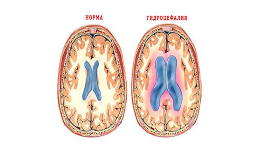 Гидроцефалия головного мозга у ребенка фото
