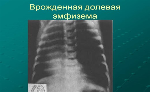 Врожденная лобарная эмфизема клиника рентгенологическая картина принципы лечения