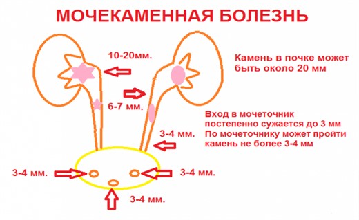 Почечная колика мочекаменная болезнь карта вызова смп