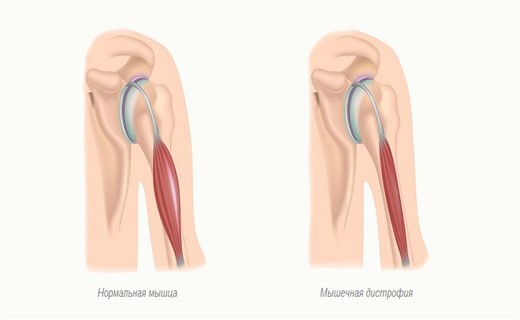 Фото мышечной дистрофии