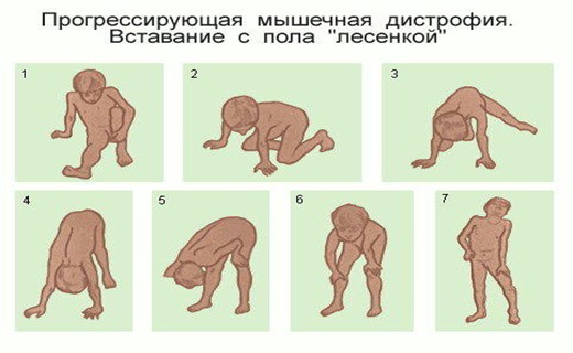 Эрба рота мышечная дистрофия