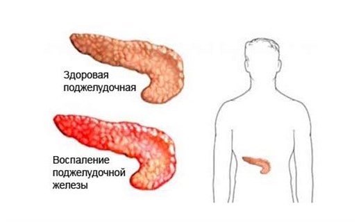 Панкреатит где находится у человека фото