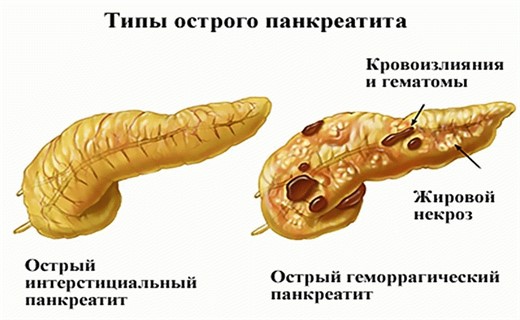 Клиническая картина панкреатита