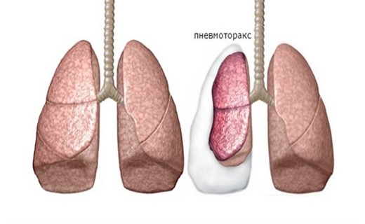 Пневмоторакс закрытый фото