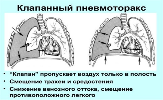 Клапанный пневмоторакс презентация