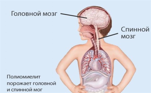 Клиническая картина полиомиелита