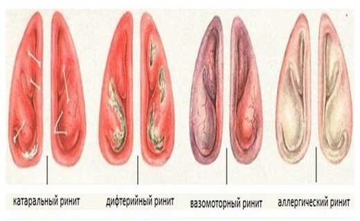 Риноскопическая картина при аллергическом рините