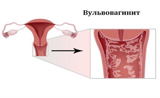 Вульвит у девочек картинки